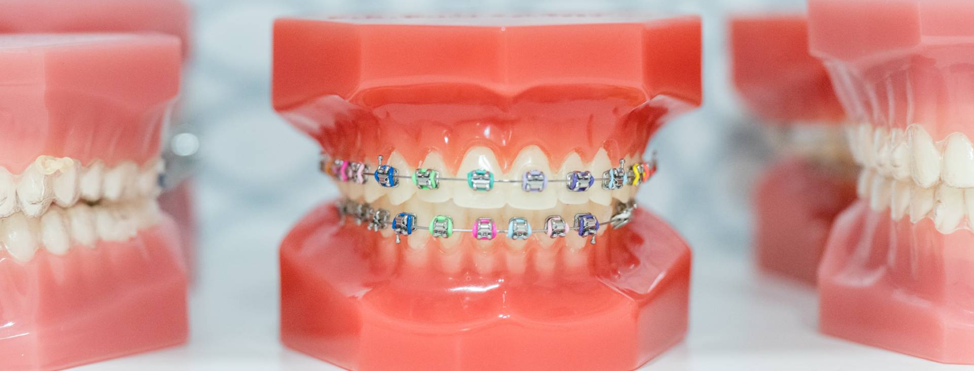 Types of Braces Shlash Orthodontics in Olney, MD